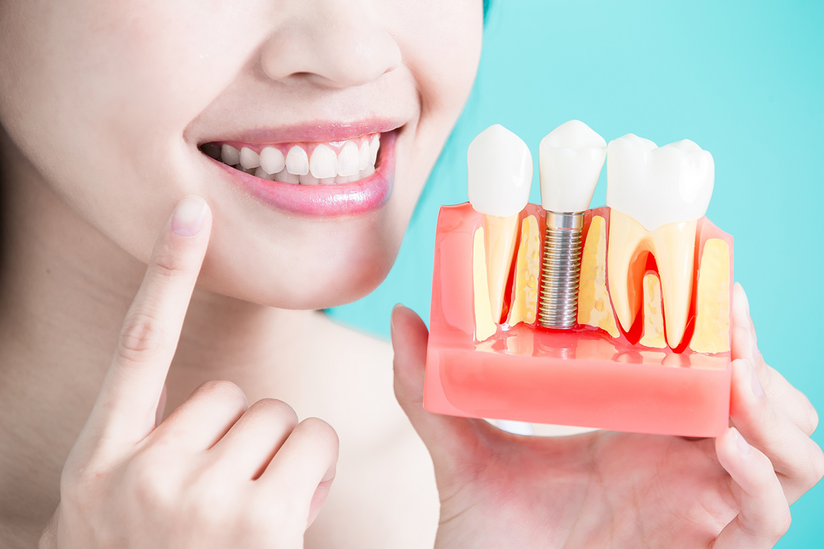 Implantes Dentários