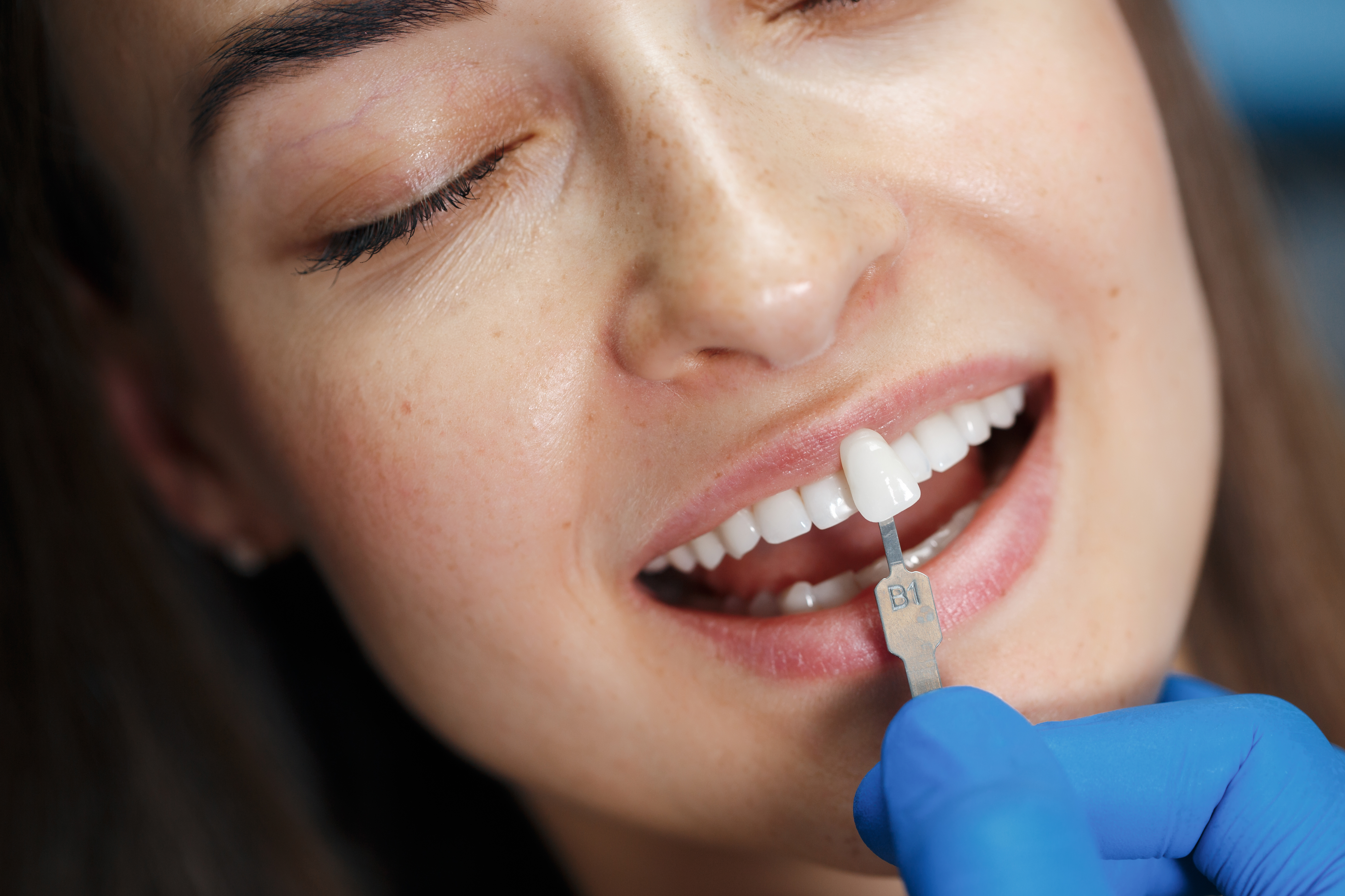 Lentes de Contato Dental